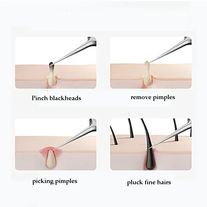 Acne & Blackhead Removal Tool Set — Stainless Steel